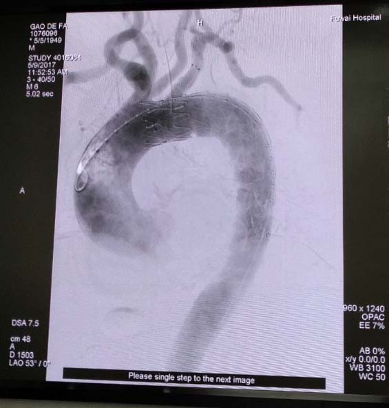 术后造影显示，支架植入后状态佳，无内漏.jpg