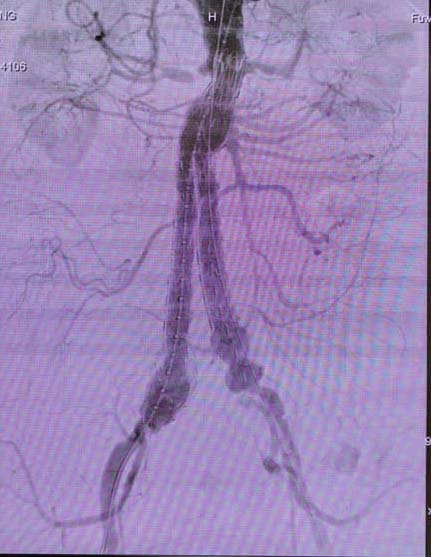 术后造影显示双侧肾动脉畅达，封堵成效极佳.jpg