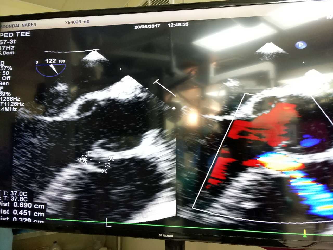 第二台手术术中超声.jpg