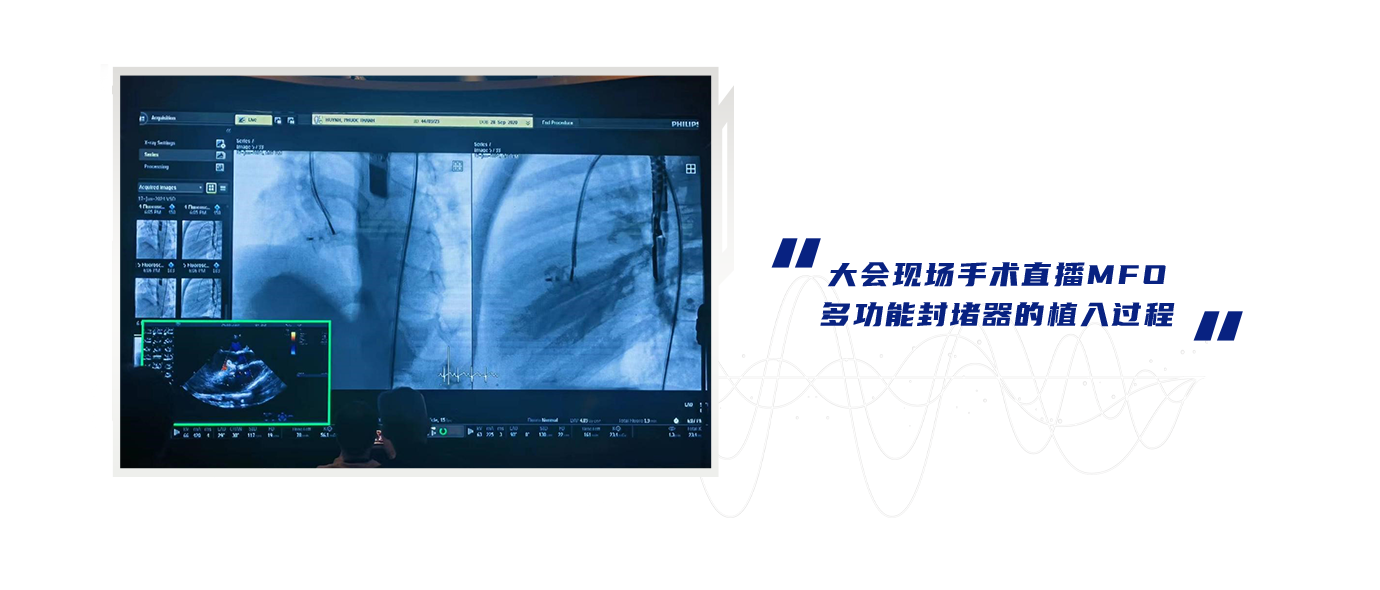 大会现场手术直播MFO多职能封堵器的植入过程.png